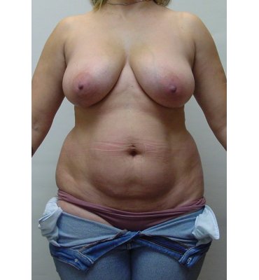 breast lift/reduction, tummy tuck, liposuction before